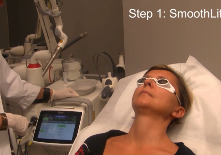 Ansiktsbehandling med 4D-laser